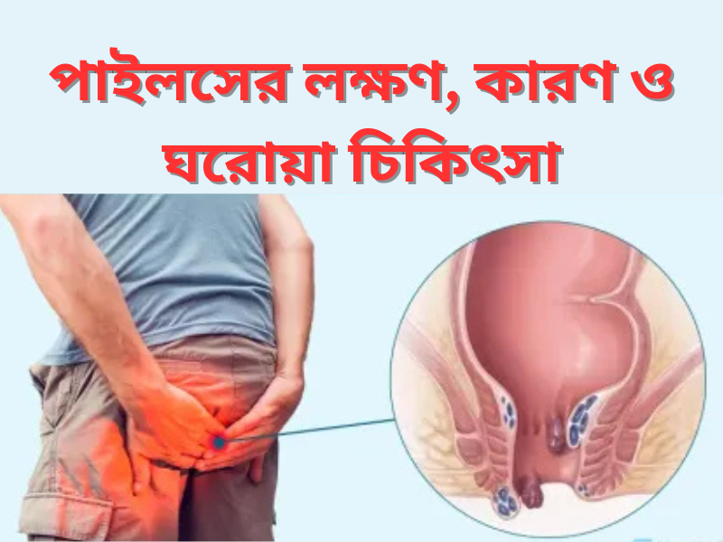 You are currently viewing Piles Symptoms, Causes, and Home Remedies-পাইলসের লক্ষণ, কারণ ও ঘরোয়া চিকিৎসা